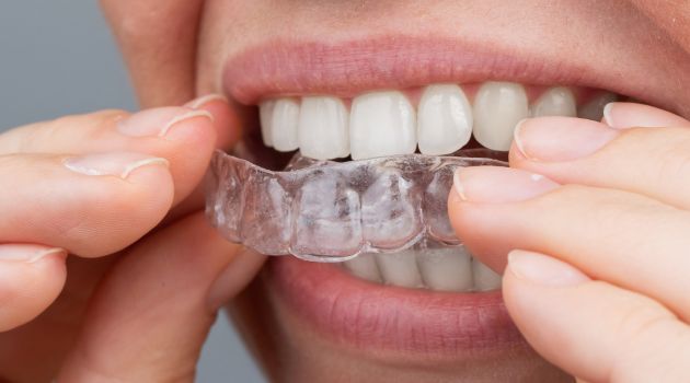 Zdrowy Uśmiech z Invisalign – Nowoczesne Nakładki Ortodontyczne